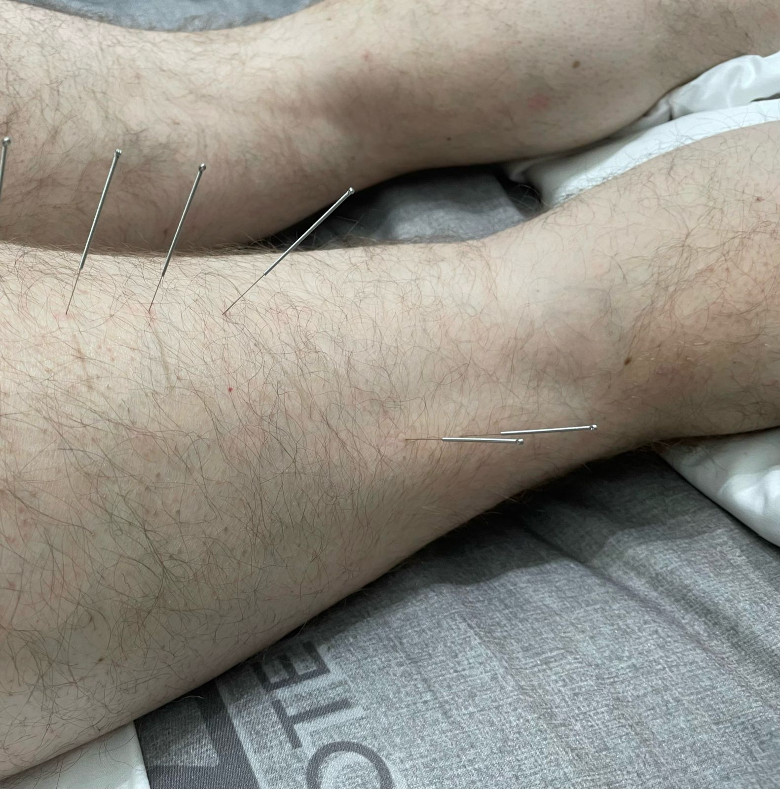 acupuncture