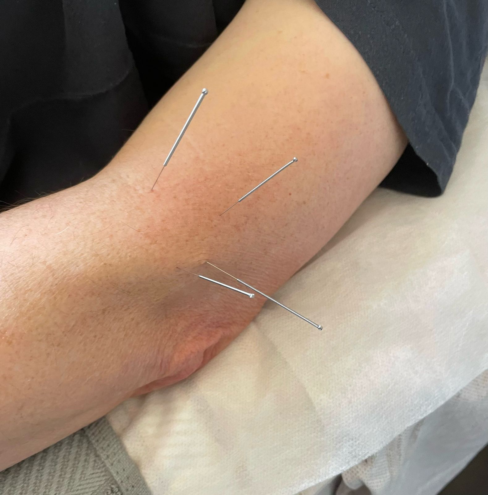 acupuncture