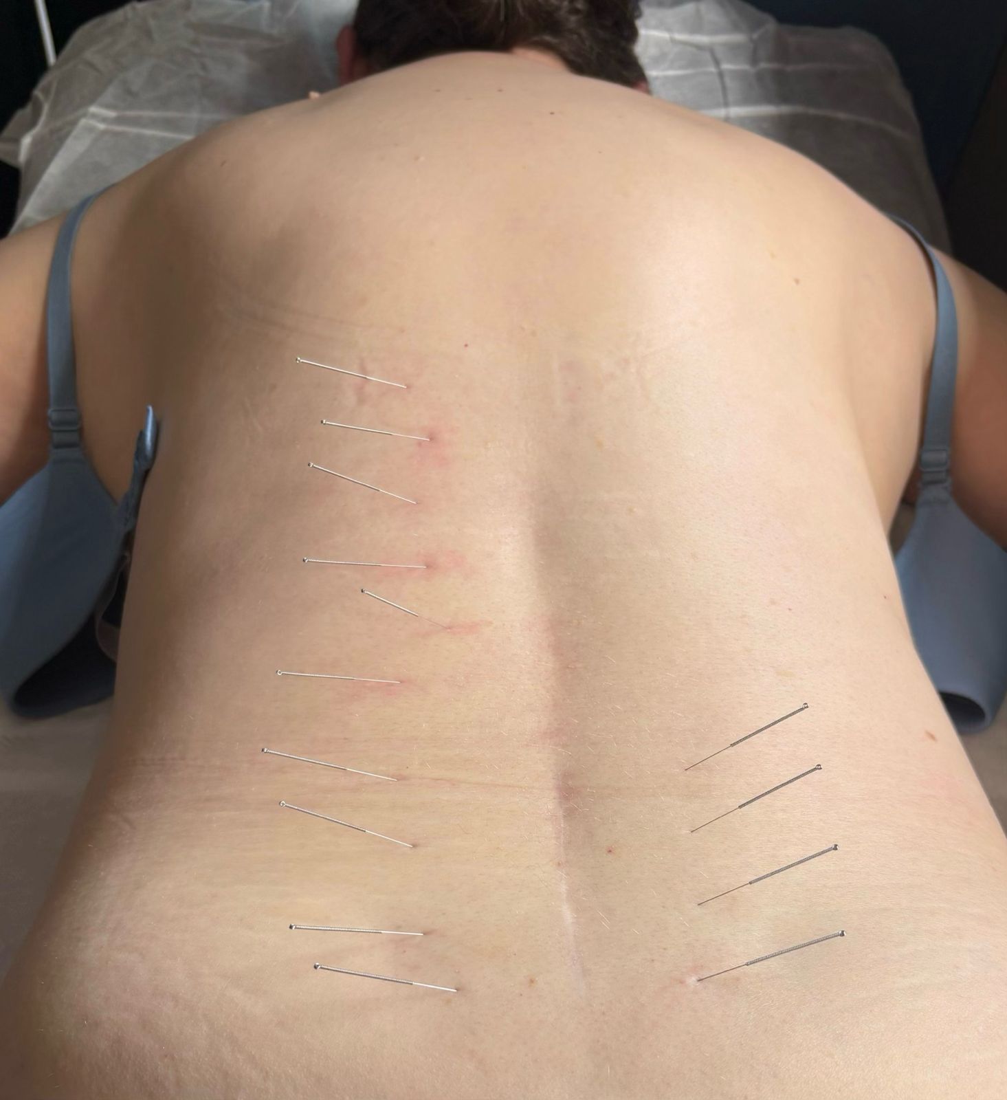 acupuncture