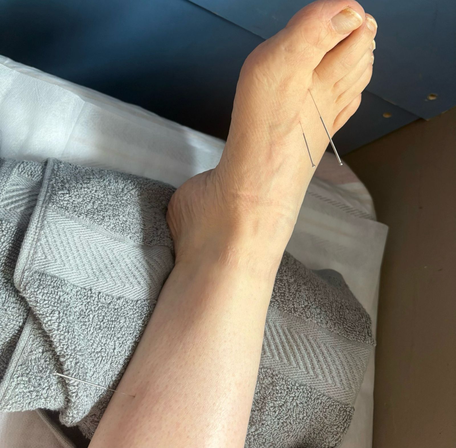 acupuncture
