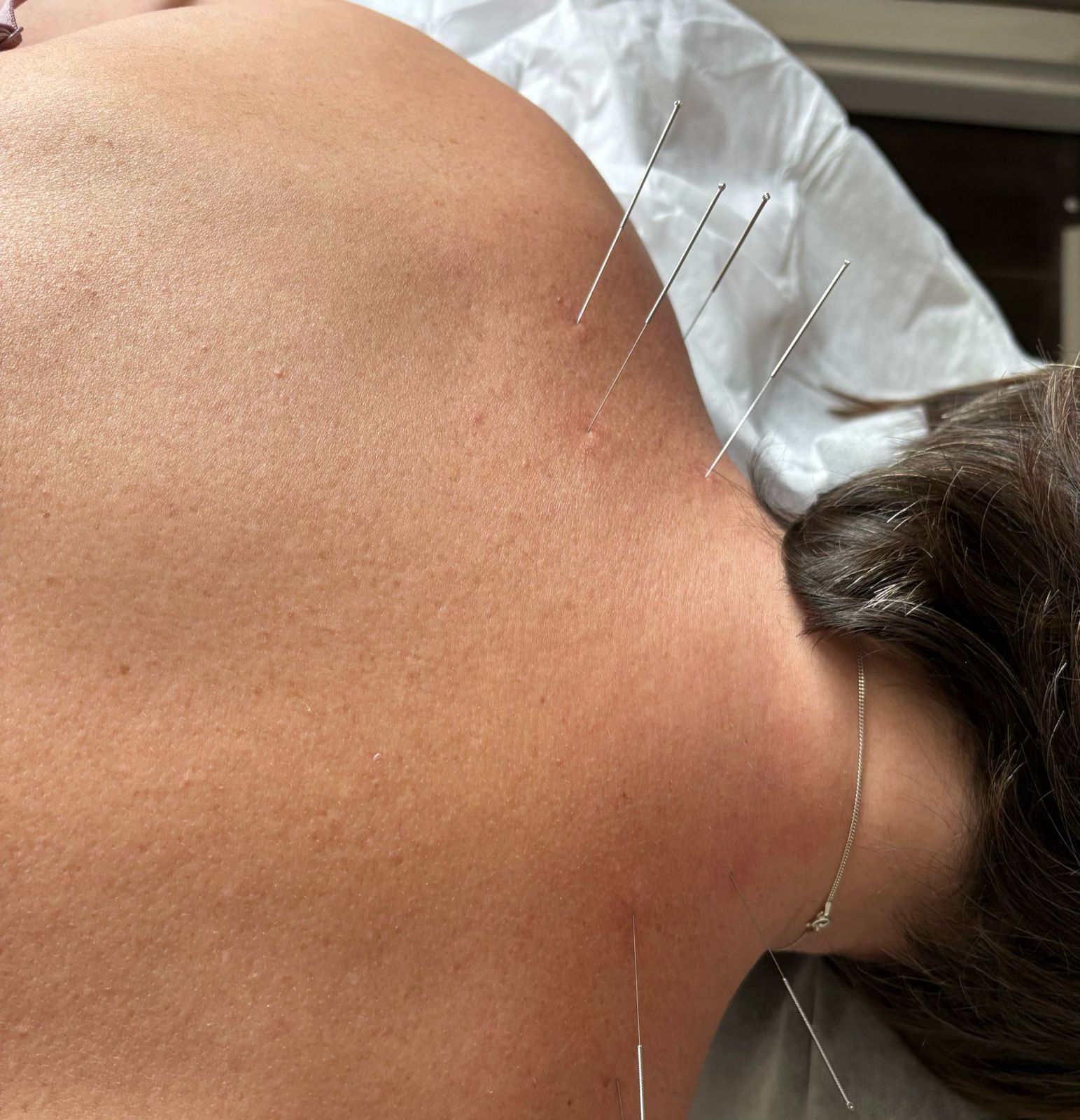 acupuncture